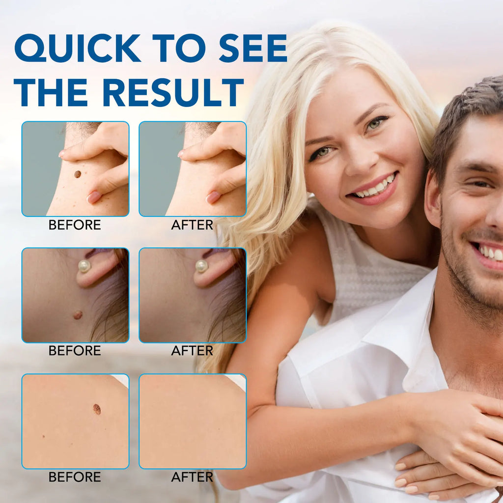 Advanced Skin Tag & Wart Remover