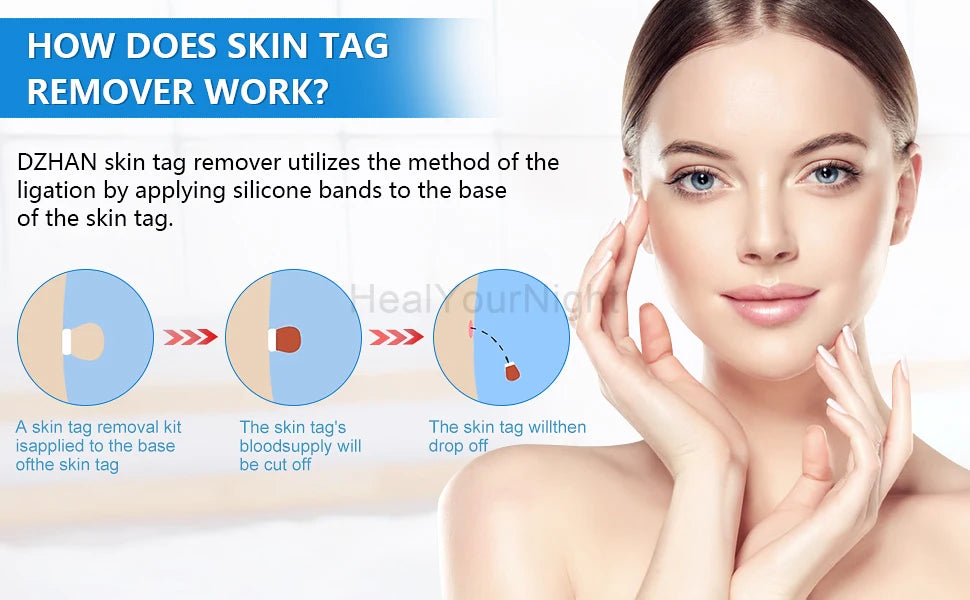 Advanced Skin Tag & Wart Remover