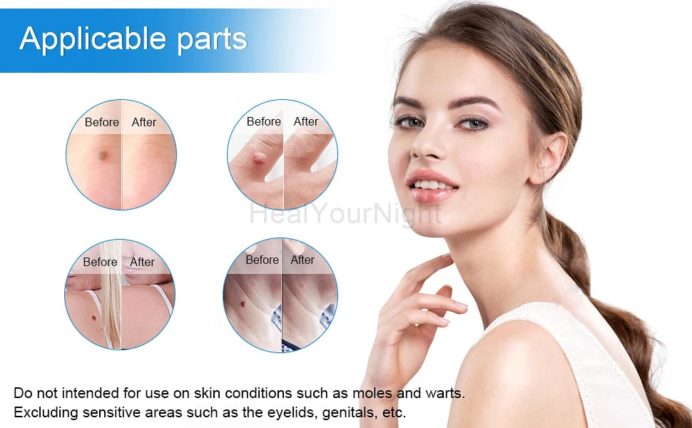 Advanced Skin Tag & Wart Remover