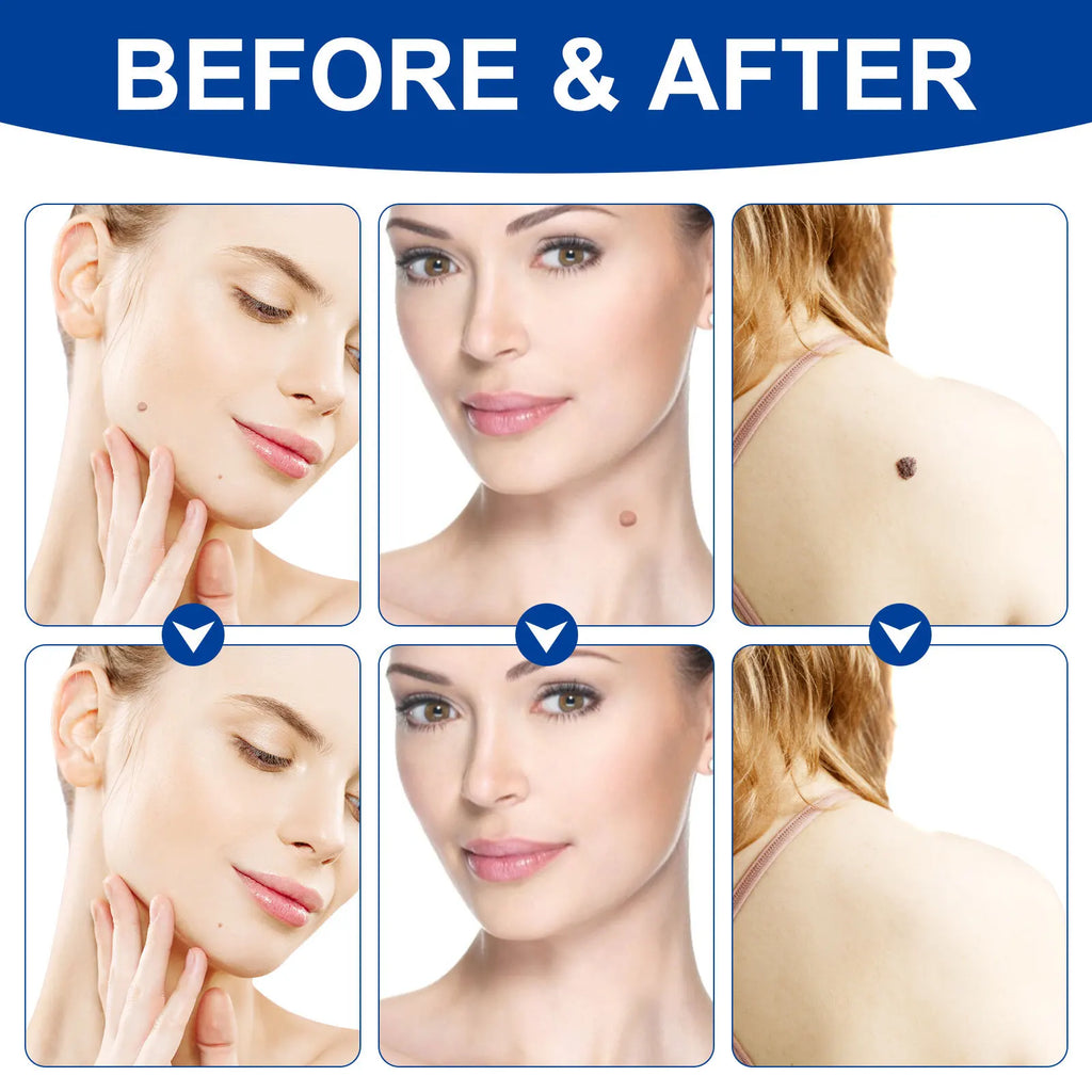 Advanced Skin Tag & Wart Remover