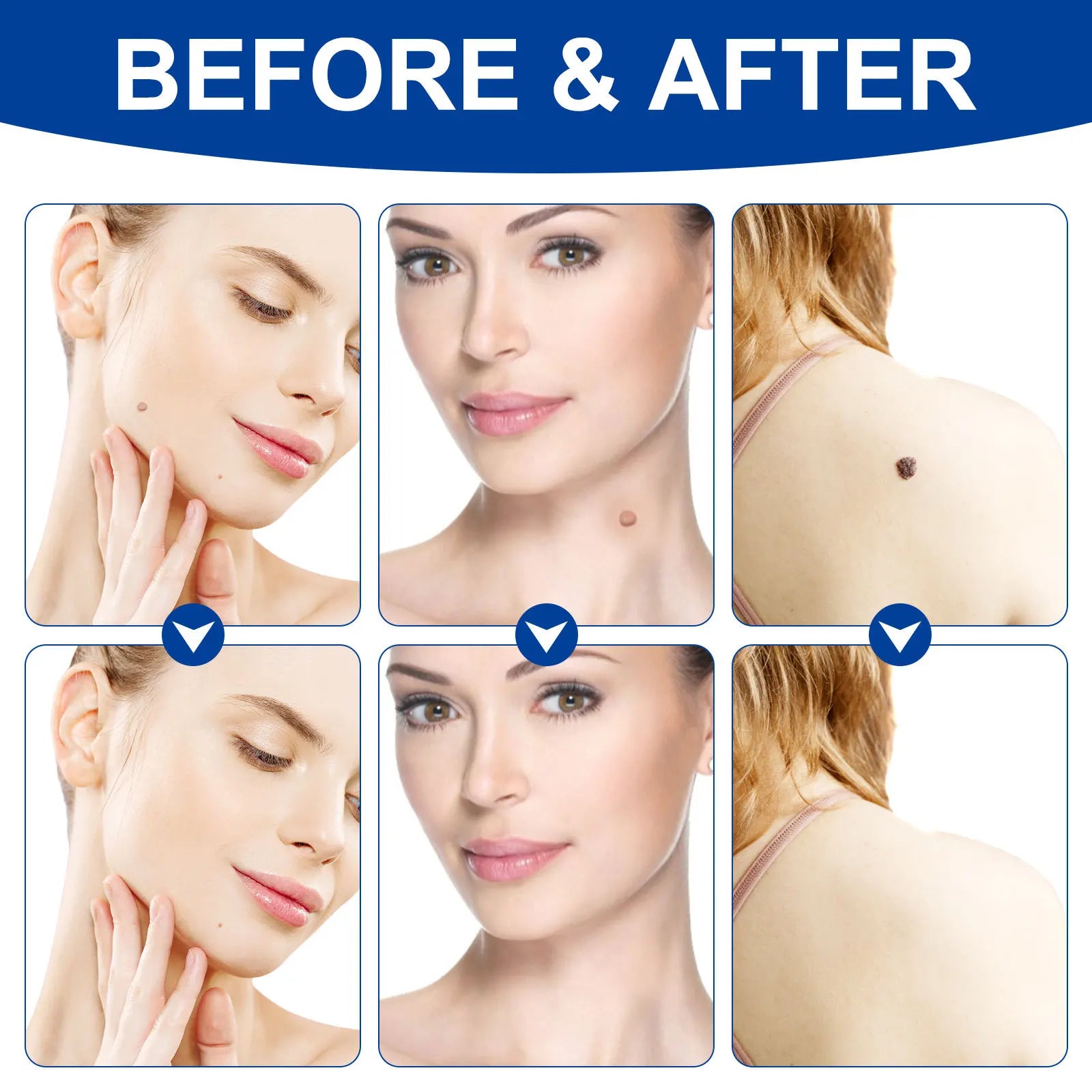Advanced Skin Tag & Wart Remover