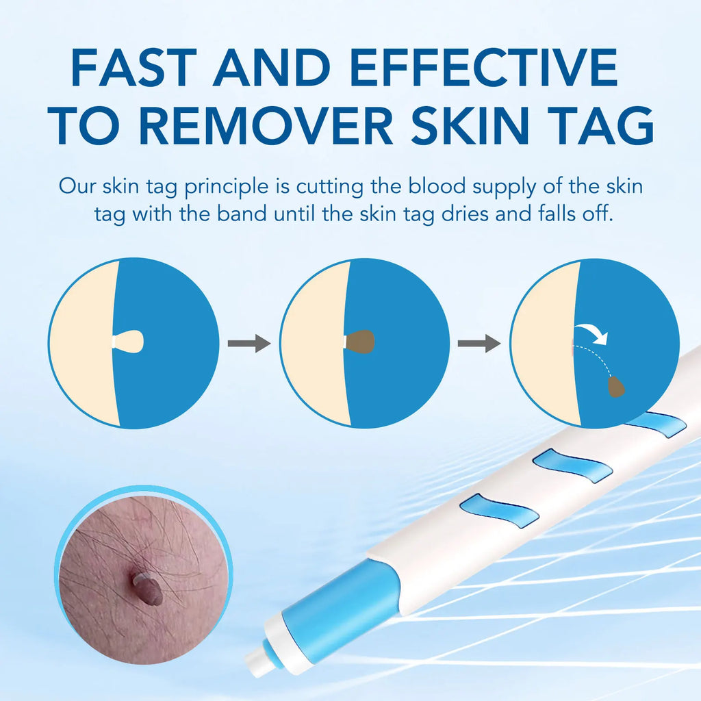 Advanced Skin Tag & Wart Remover