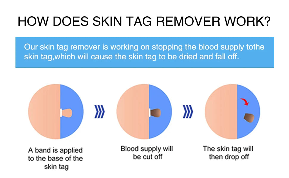 Advanced Skin Tag & Wart Remover