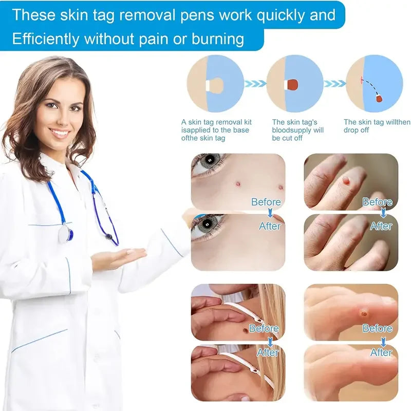 Advanced Skin Tag & Wart Remover