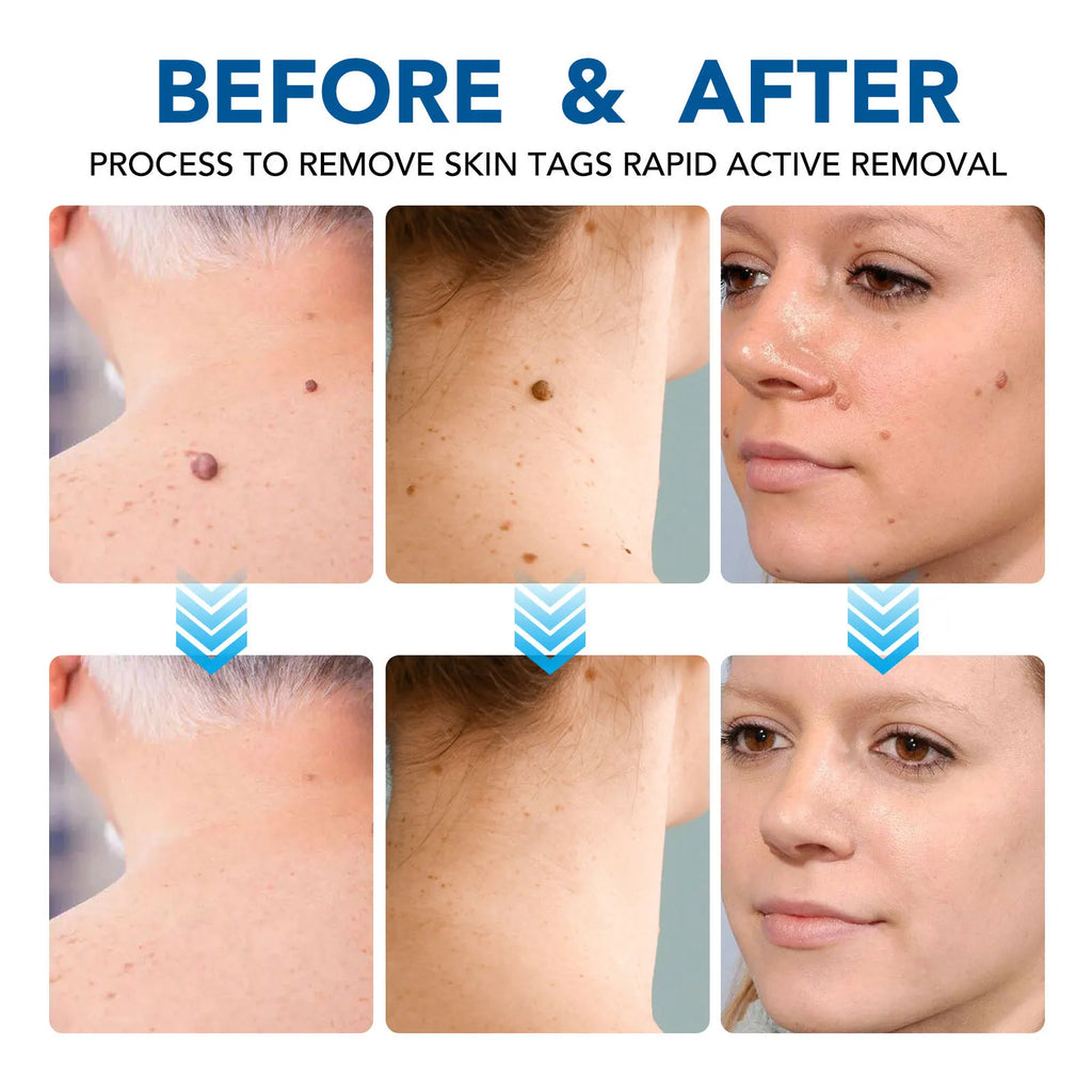 Advanced Skin Tag & Wart Remover